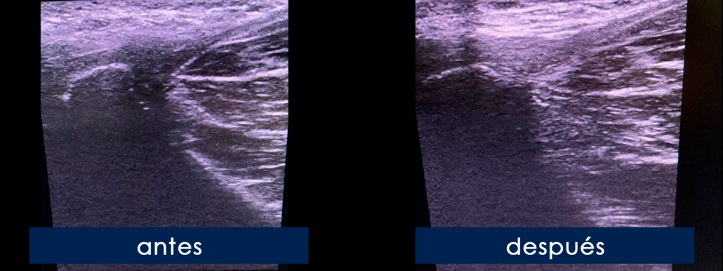 Pubalgia Terapia Diam gnetica