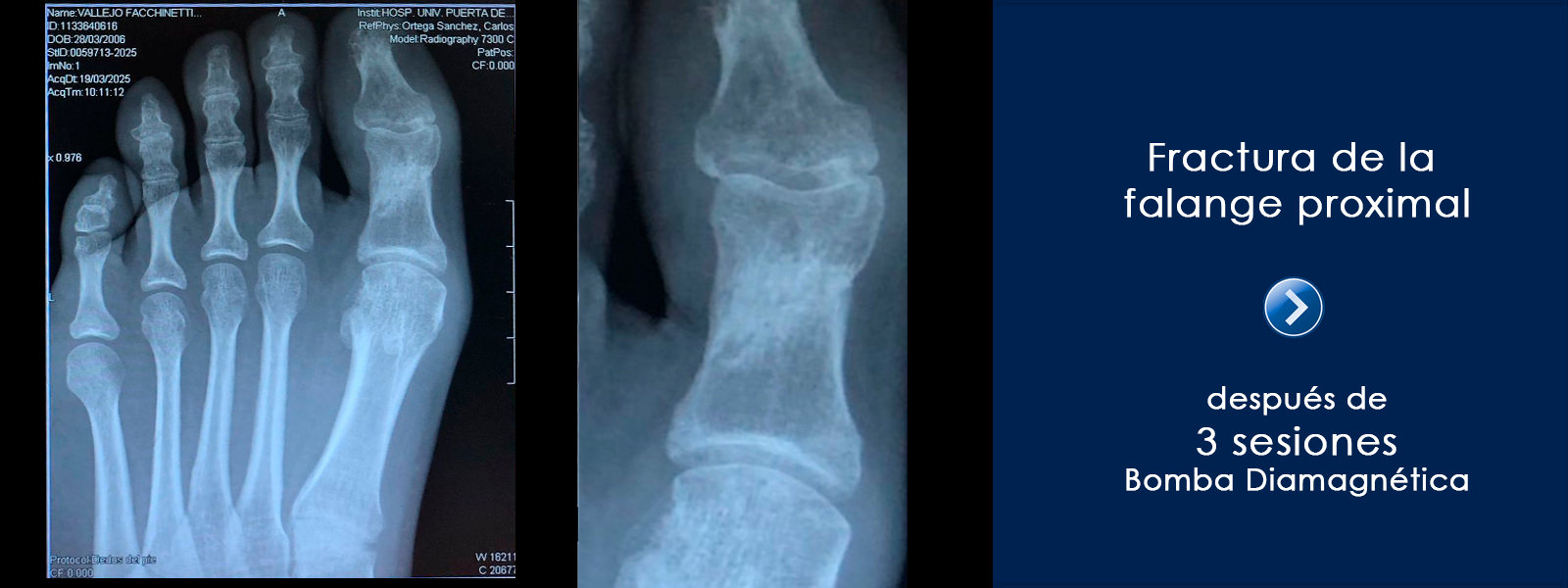 tratamiento_fractura_falange_bomba_diamagnetica_fisioglobal_2