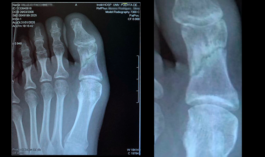tratamiento_fractura_falange_bomba_diamagnetica_fisioglobal_antes