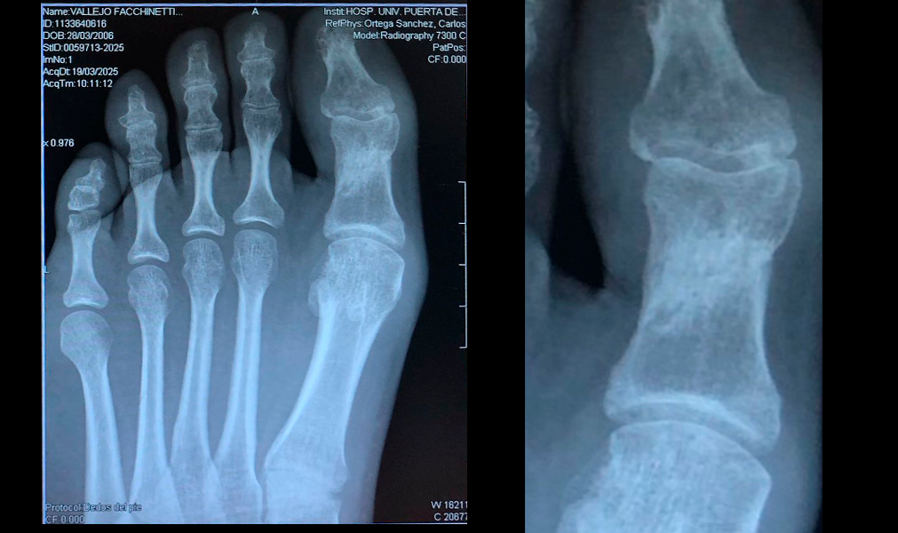 tratamiento_fractura_falange_bomba_diamagnetica_fisioglobal_despues