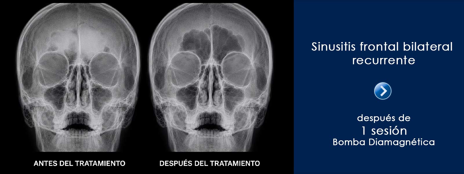 Sinusitis-frontal-bilateral---montoro-servicios-clinicos