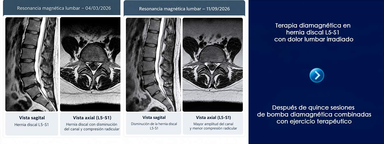 terapia-diamagnetica-hernia-discal-L5S1